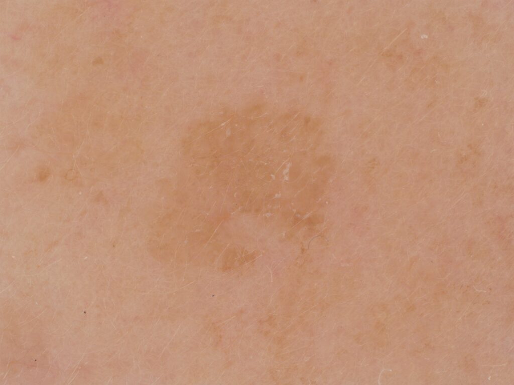effet antioxydant - pigmentation