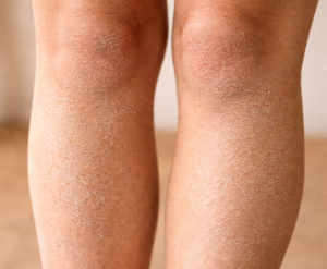 Sécheresse des jambes